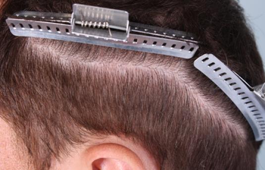 Hair Transplant&nbsp;Trichophytic Donor Scars
